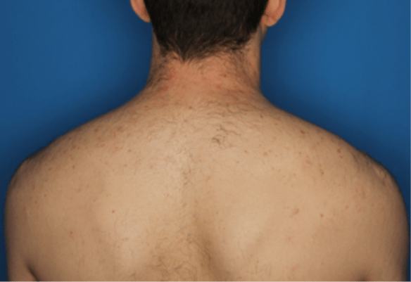 Μετά τη θεραπεία αποτρίχωσης