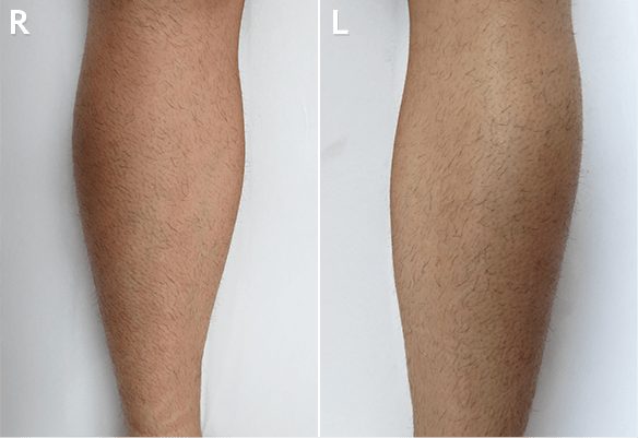 Πριν τη θεραπεία αποτρίχωσης