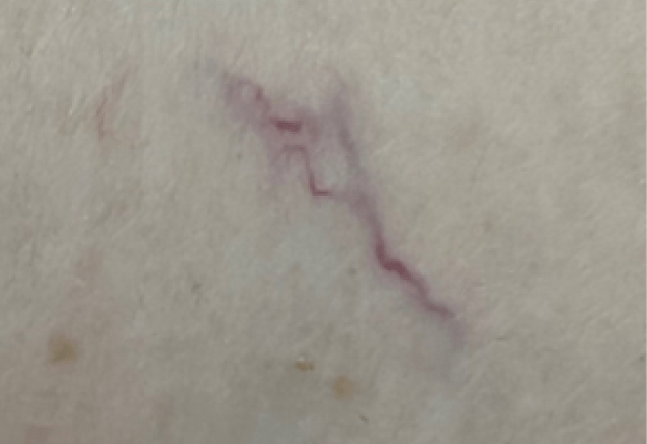 Πριν τη θεραπεία αγγειακών βλαβών