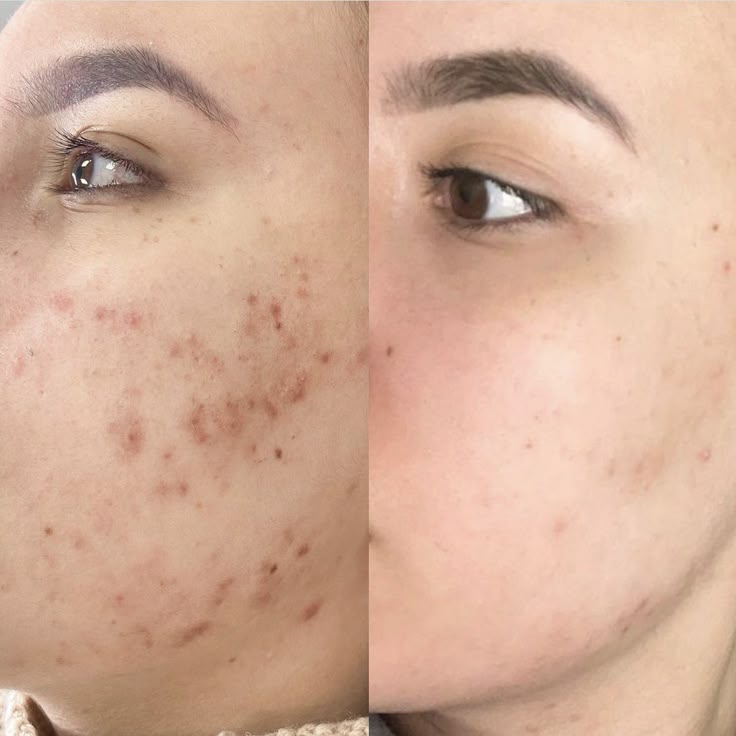 Chemical Peel Treatment