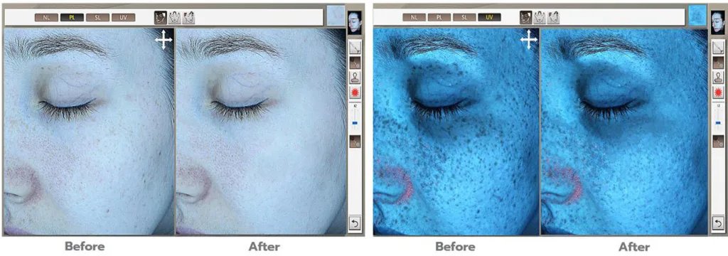 Skin Analysis - RGB Imaging