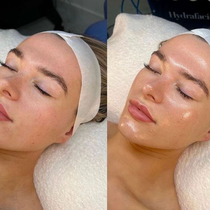 Υδροδερμοαπόξεση