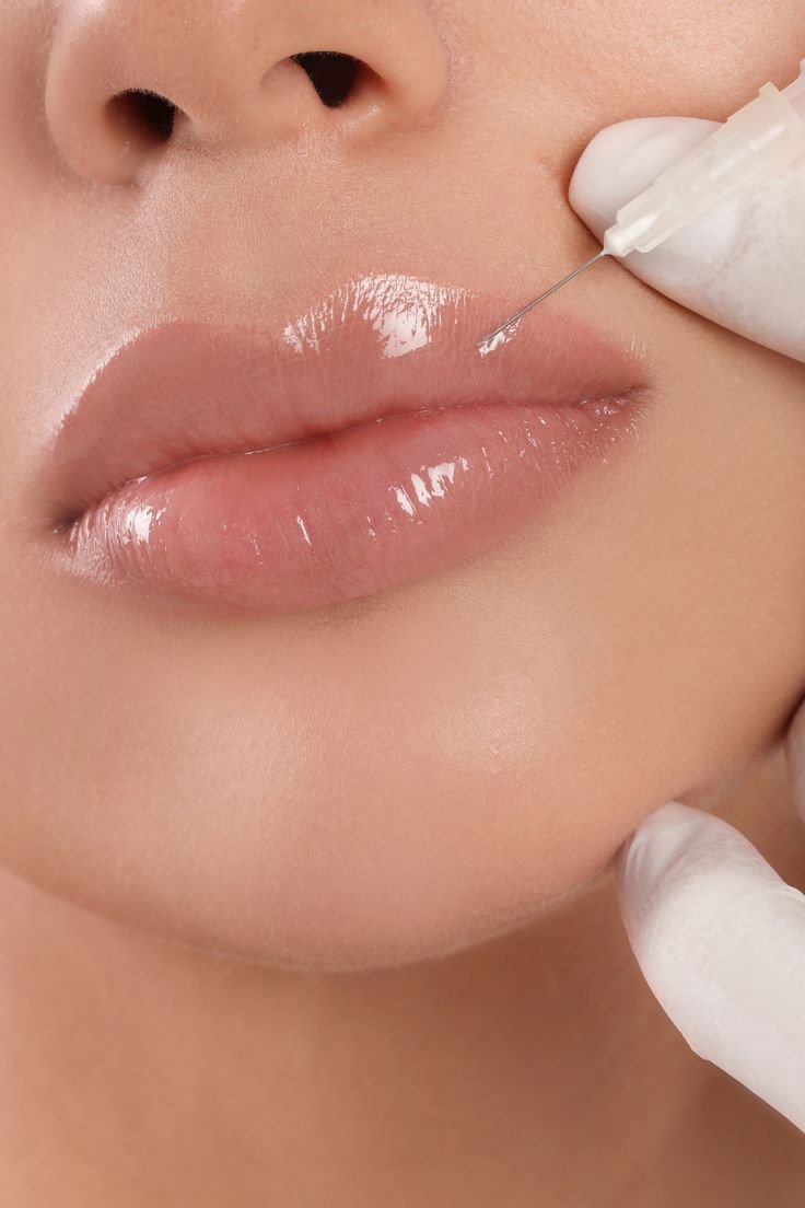 Αποτέλεσμα αύξησης χειλιών — πριν και μετά lip fillers Σαλαμίνα