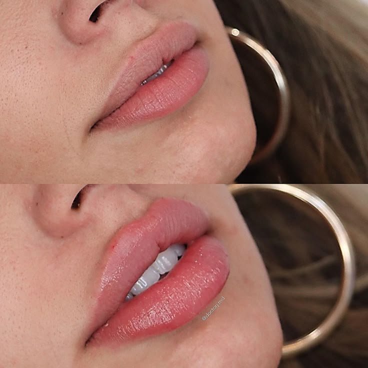 Φυσικά χείλη μετά από αυξητική χειλιών στο MB Aesthetic Clinic