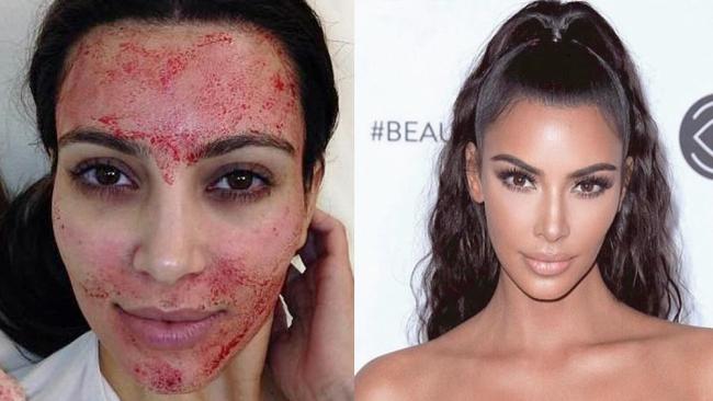 Dermapen 4 + Vampire Lift VIP