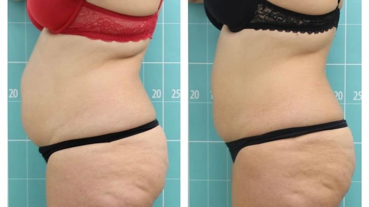 ZIONIC results after 10 sessions