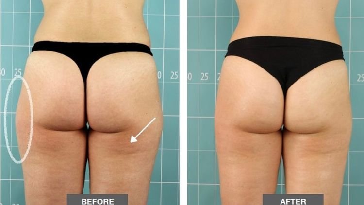 ZIONIC results after 8 sessions